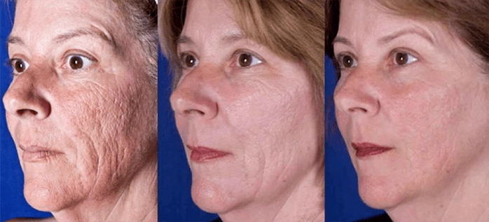 Az eredmény a lézeres arcbőrfiatalító eljárás után